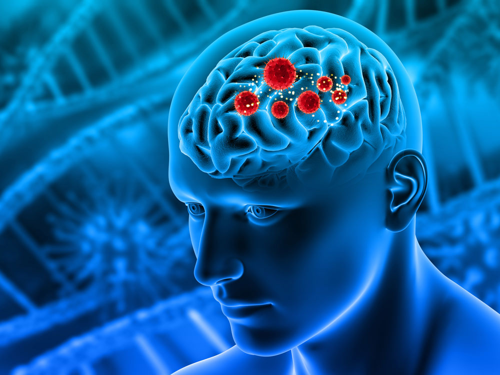 Brain Tumors