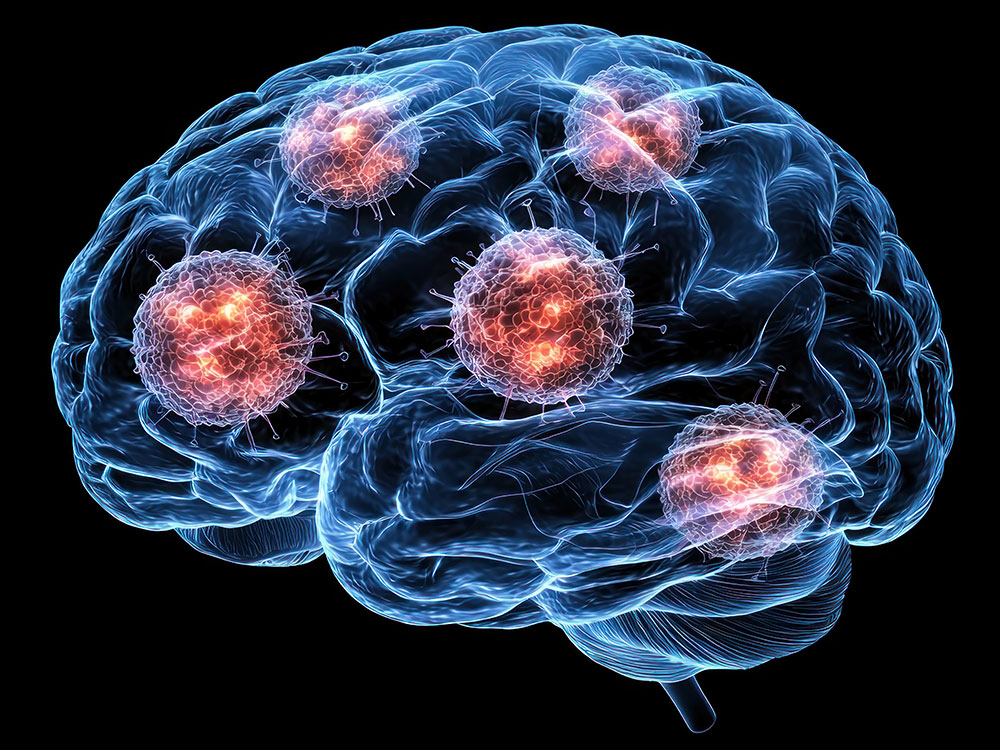 Neurological Complication